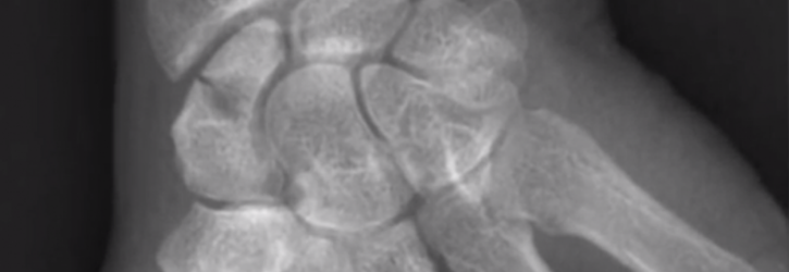 Undiagnosed Fracture Claims